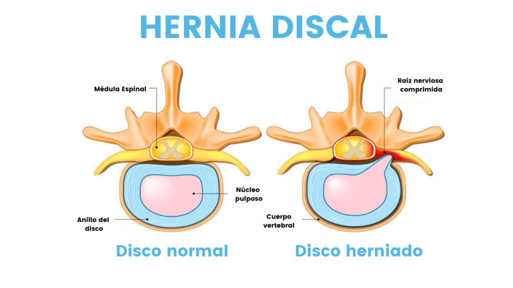 Rehabilitación de dolor lumbar - Hernia discal